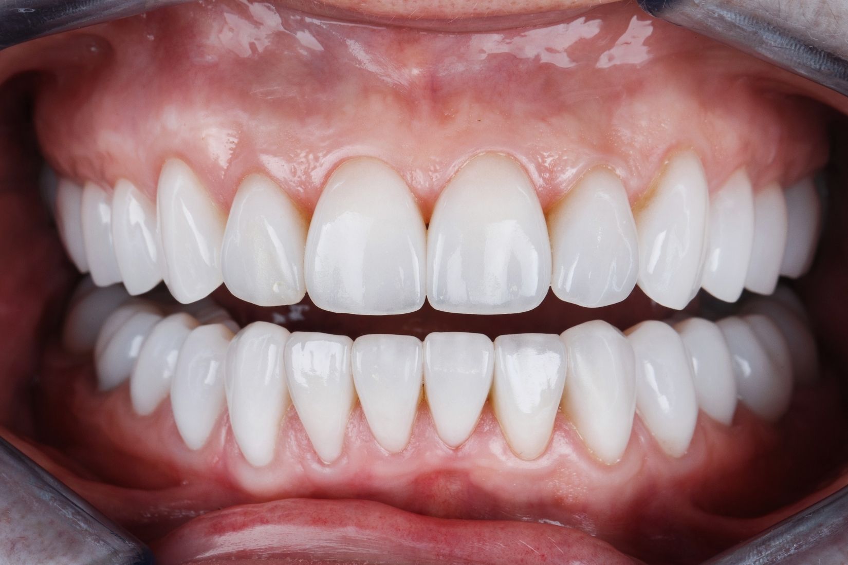 Ön diş estetiği değerlendirmesi, diş formu ve gülüş analizi sürecini gösteren profesyonel dental görsel.