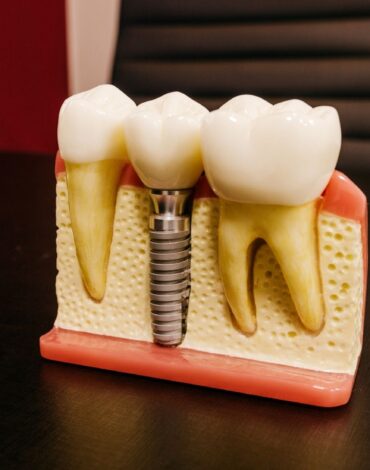 İmplant öncesi kemik grefti planlaması ve çene kemiği değerlendirmesini gösteren dental görsel.