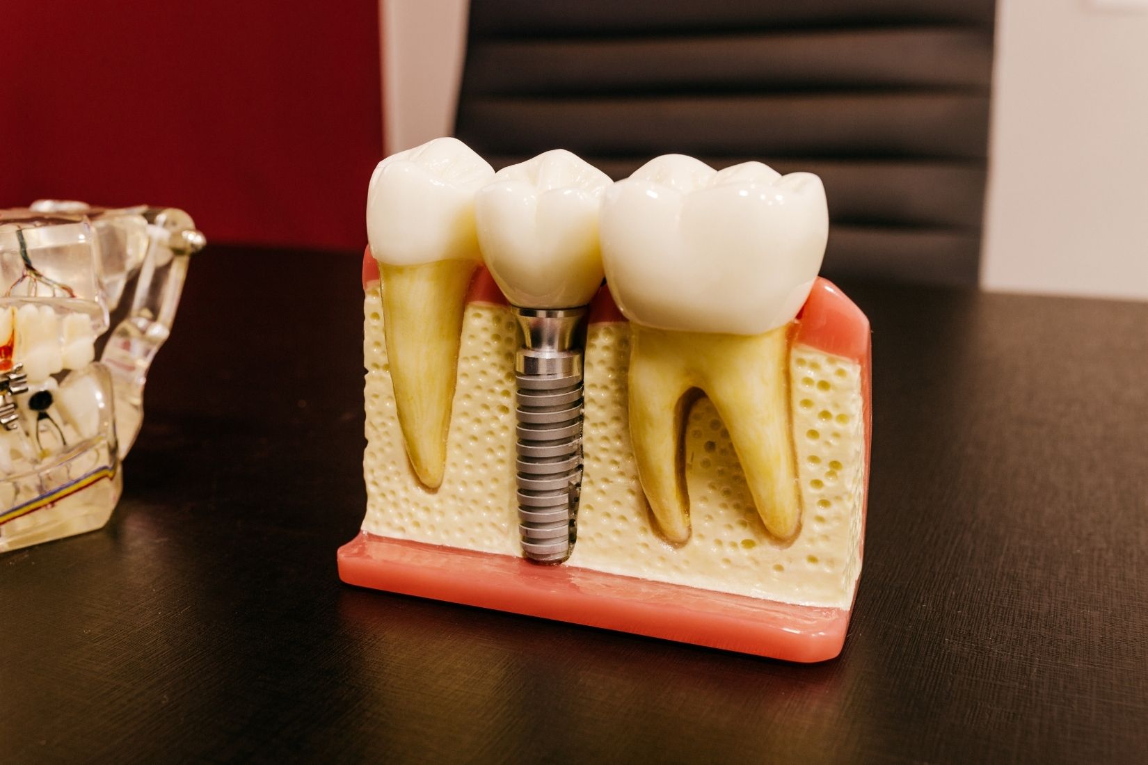 İmplant öncesi kemik grefti planlaması ve çene kemiği değerlendirmesini gösteren dental görsel.