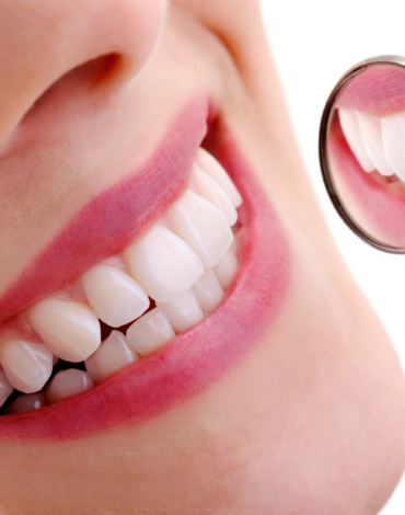 Ön dişlerde kompozit bonding uygulamasının planlama ve şekillendirme sürecini gösteren dental görsel.