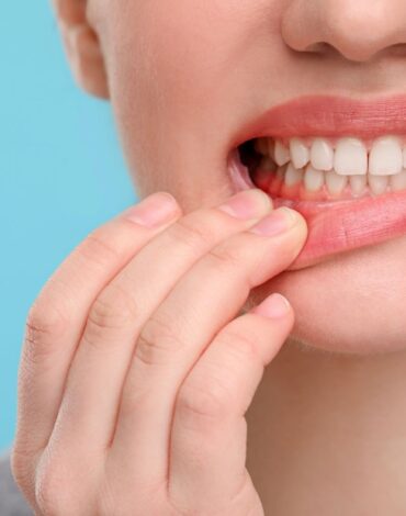Diş taşı temizliği öncesi ve sonrası ağız hijyeni değerlendirmesini gösteren dental muayene görseli.