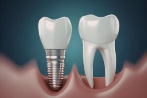 Tam dişsizlikte full mouth implant planlaması ve implant destekli sabit protez değerlendirmesini gösteren görsel.