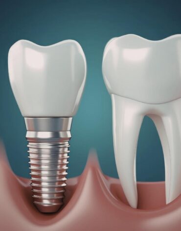 Tam dişsizlikte full mouth implant planlaması ve implant destekli sabit protez değerlendirmesini gösteren görsel.