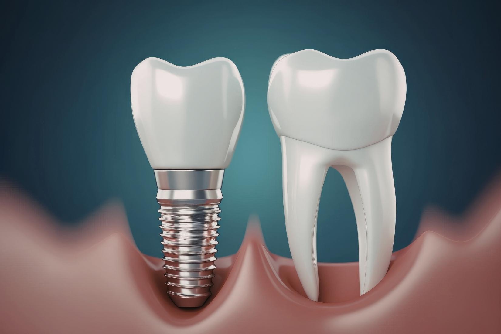 Tam dişsizlikte full mouth implant planlaması ve implant destekli sabit protez değerlendirmesini gösteren görsel.