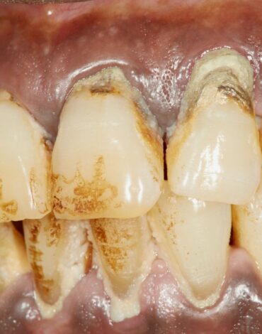 Çene kemiği kaybının radyolojik değerlendirilmesi ve ağız içi muayene sürecini gösteren dental görsel.
