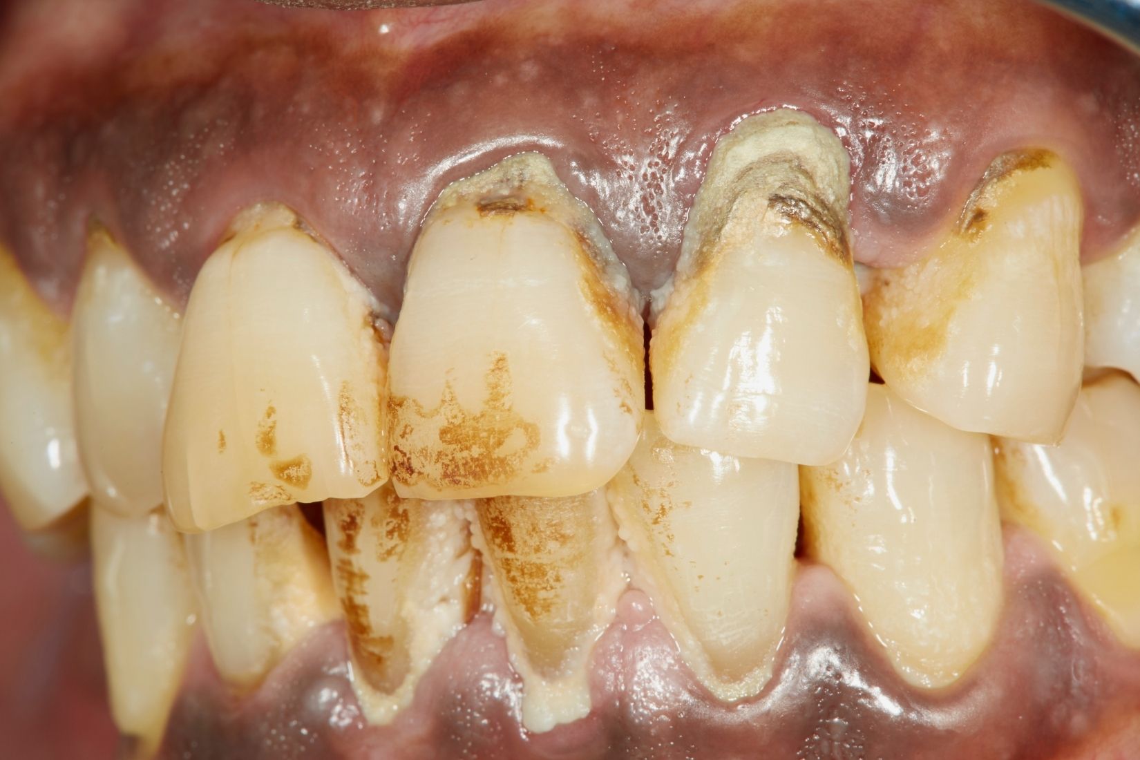 Çene kemiği kaybının radyolojik değerlendirilmesi ve ağız içi muayene sürecini gösteren dental görsel.