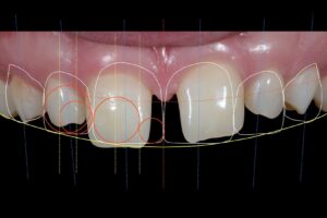 Ön diş estetiği planlamasında diş, diş eti ve gülüş analizinin değerlendirildiği dental görsel.