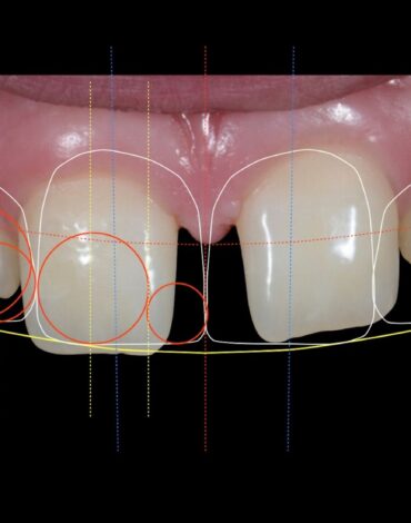 Ön diş estetiği planlamasında diş, diş eti ve gülüş analizinin değerlendirildiği dental görsel.