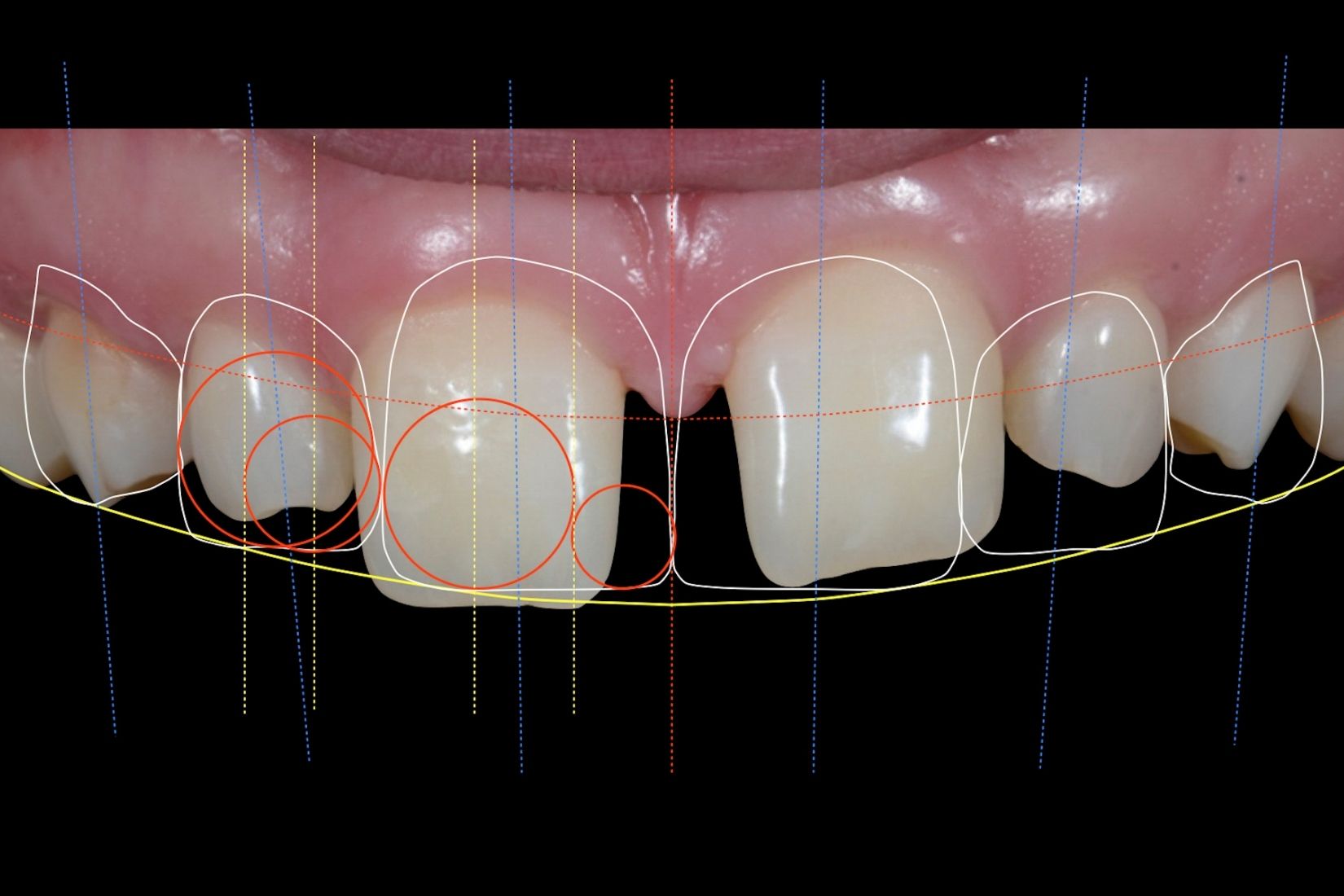 Ön diş estetiği planlamasında diş, diş eti ve gülüş analizinin değerlendirildiği dental görsel.