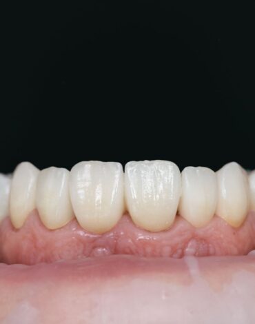 Zirkonyum kaplama planlaması, diş değerlendirmesi ve estetik restorasyon sürecini gösteren dental görsel.