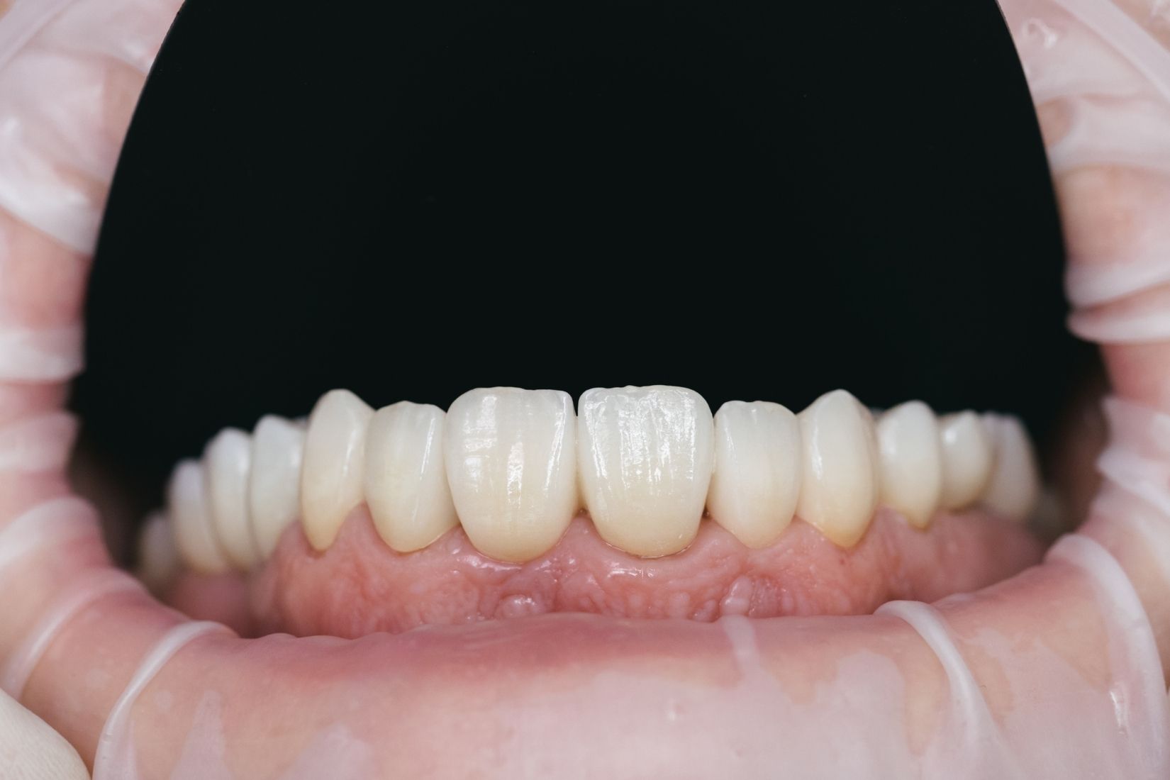 Zirkonyum kaplama planlaması, diş değerlendirmesi ve estetik restorasyon sürecini gösteren dental görsel.