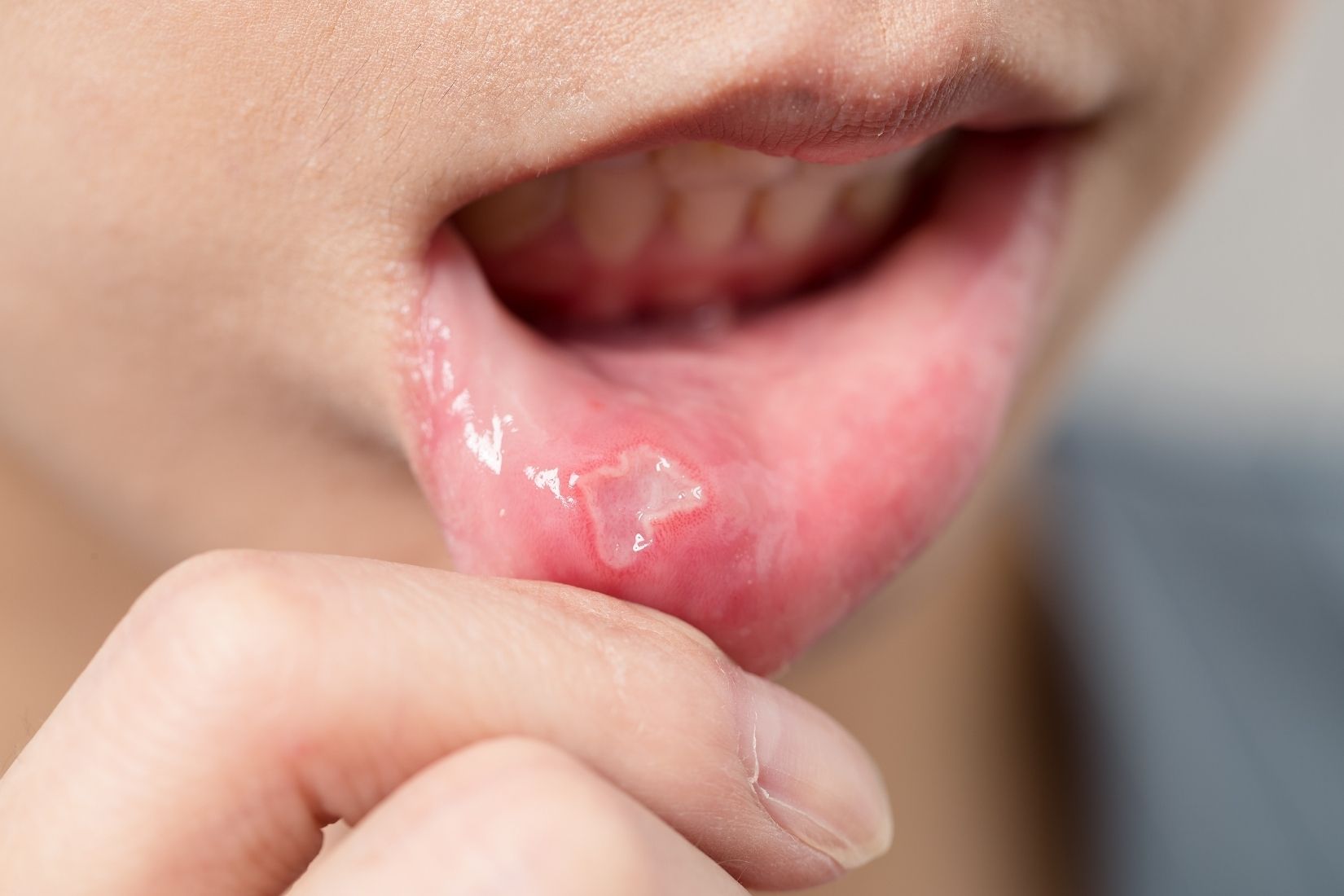 Ağız mukozasında görülen beyaz lezyonların klinik değerlendirilmesini gösteren dental muayene görseli.