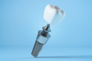 implant-cevresinde-kanama-neden-gorulebilir