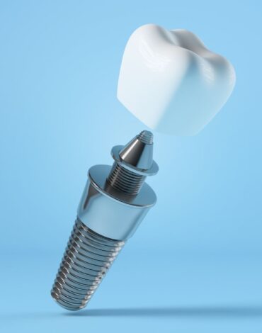 implant-cevresinde-kanama-neden-gorulebilir