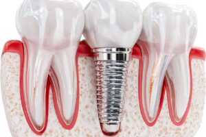 Peri-implantitis nedir? İmplant çevresi dokuların sağlığı, belirtileri ve değerlendirme süreci hakkında bilgiler.
