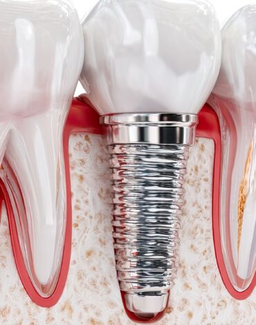 Peri-implantitis nedir? İmplant çevresi dokuların sağlığı, belirtileri ve değerlendirme süreci hakkında bilgiler.