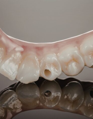 Toronto protez planlamasında implant destekli sabit protezin dijital değerlendirme sürecini gösteren görsel.