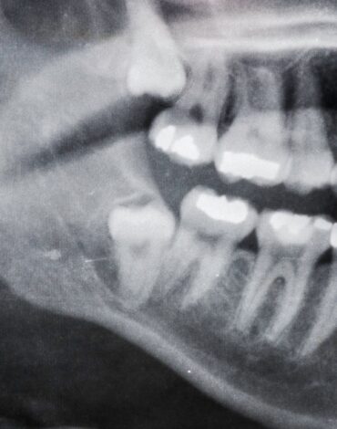 Gömülü dişin çene kemiği ve komşu yapılarla ilişkisinin radyolojik olarak değerlendirildiği dental görsel.