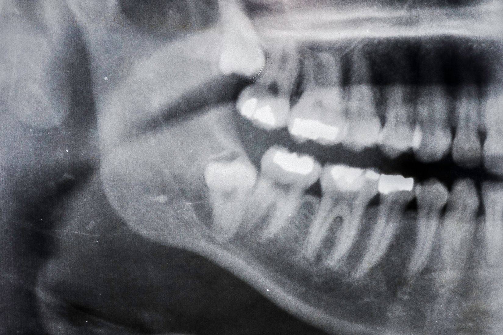 Gömülü dişin çene kemiği ve komşu yapılarla ilişkisinin radyolojik olarak değerlendirildiği dental görsel.