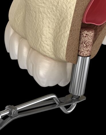 Üst çene arka bölgede implant öncesi sinüs boşluğu ve mevcut kemik yüksekliğinin radyolojik olarak değerlendirilmesi.