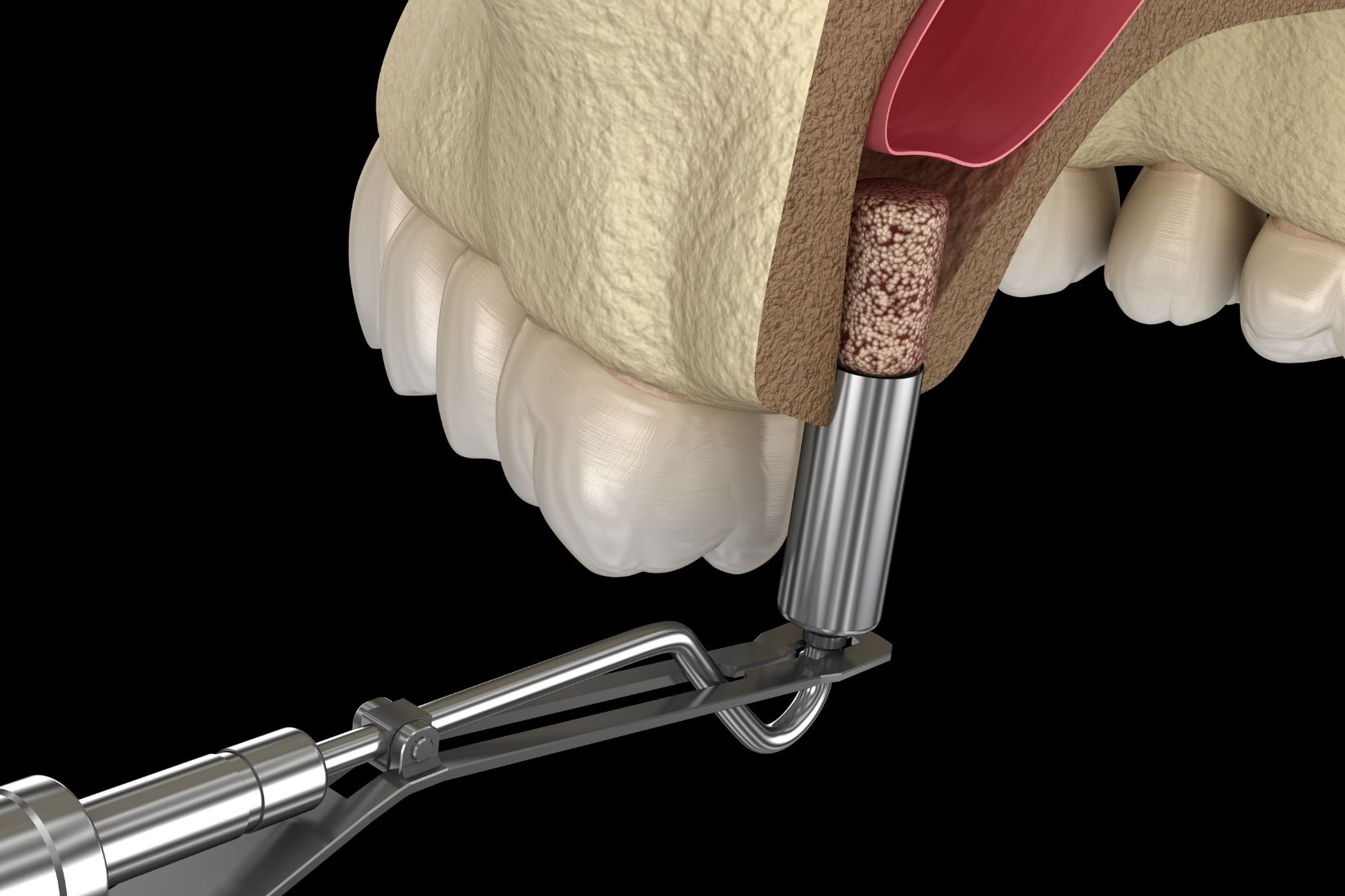 Üst çene arka bölgede implant öncesi sinüs boşluğu ve mevcut kemik yüksekliğinin radyolojik olarak değerlendirilmesi.