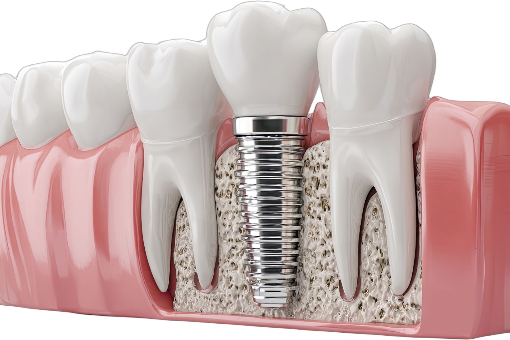 İmplant çevresindeki diş eti dokusunun peri-implant mukozitis açısından klinik olarak değerlendirilmesi.