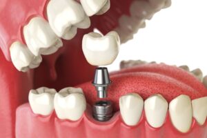 Konya implant sonrası ağrı ne zaman değerlendirilmelidir? Normal iyileşme, ağrı süreci ve dikkat edilmesi gereken belirtileri öğrenin.