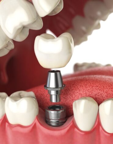 Konya implant sonrası ağrı ne zaman değerlendirilmelidir? Normal iyileşme, ağrı süreci ve dikkat edilmesi gereken belirtileri öğrenin.