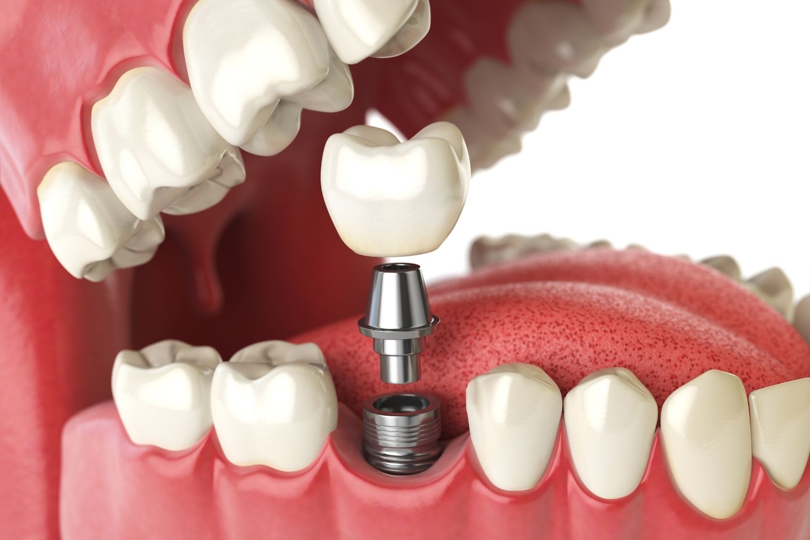 Konya implant sonrası ağrı ne zaman değerlendirilmelidir? Normal iyileşme, ağrı süreci ve dikkat edilmesi gereken belirtileri öğrenin.