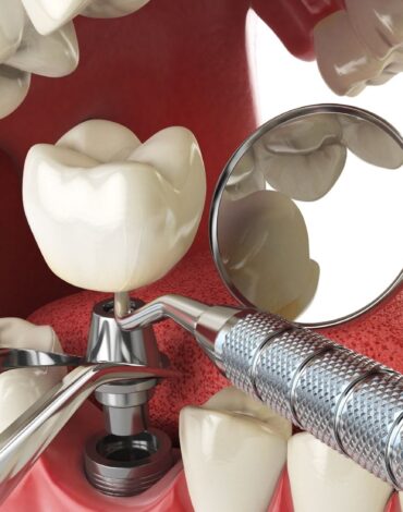 İmplant üstü kaplamada vida bağlantısının ve protez uyumunun klinik olarak değerlendirilmesini gösteren dental görsel.