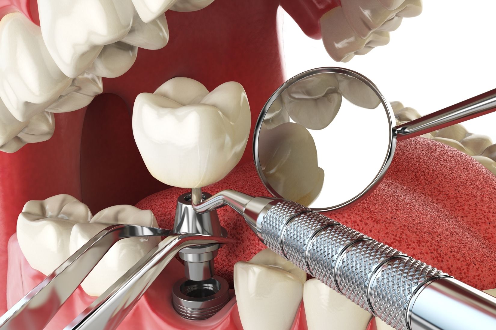 İmplant üstü kaplamada vida bağlantısının ve protez uyumunun klinik olarak değerlendirilmesini gösteren dental görsel.