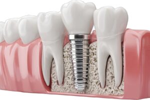 İmplant planlaması öncesinde çene kemiği yüksekliği ve kalınlığının radyolojik olarak değerlendirildiği dental görüntü.