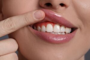 konya-periodontoloji-hangi-agiz-ve-dis-sorunlariyla-ilgilenir