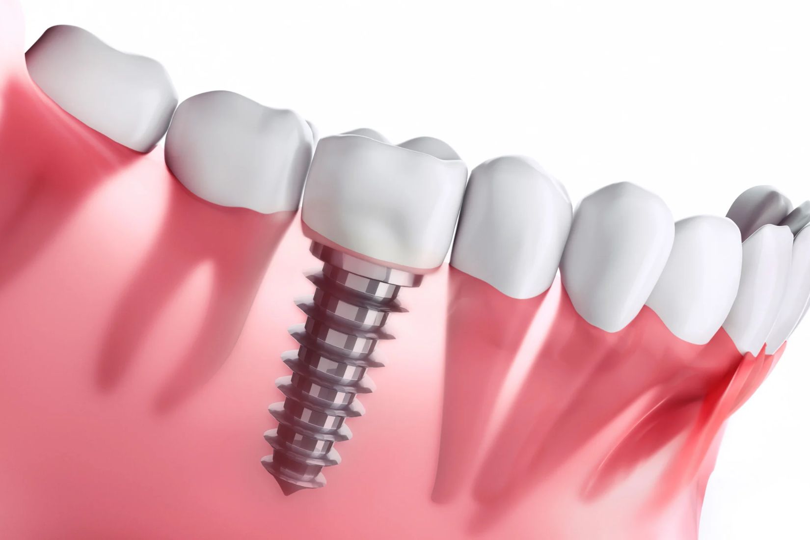 Dental implantın çene kemiğine yerleştirilmesi, osseointegrasyon ve implant üstü protez aşamalarını gösteren tıbbi çizim.