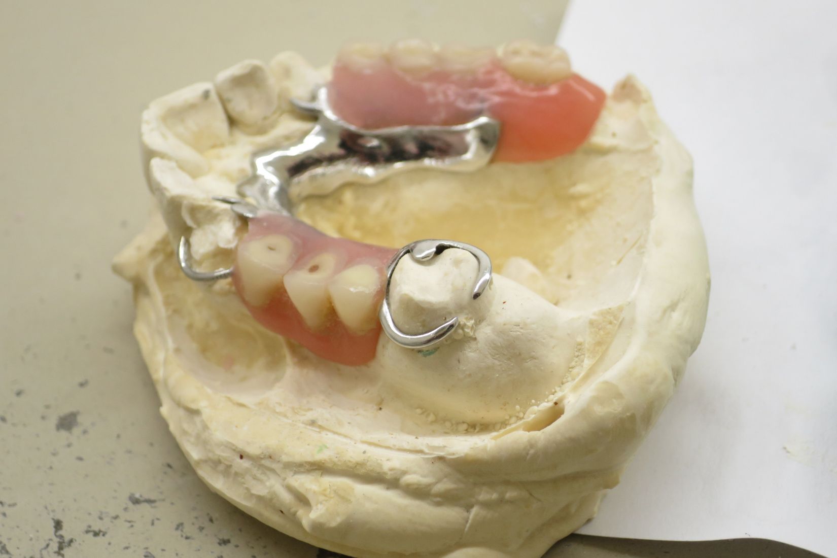 Doğal dişlere kroşelerle tutunan hareketli bölümlü protezin ağız içindeki yerleşimini ve destek yapılarını gösteren dental görsel.